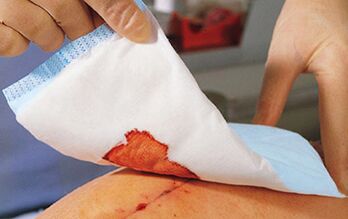 Nach einer Penisvergrößerungsoperation ist es notwendig, Bandagen anzulegen. 