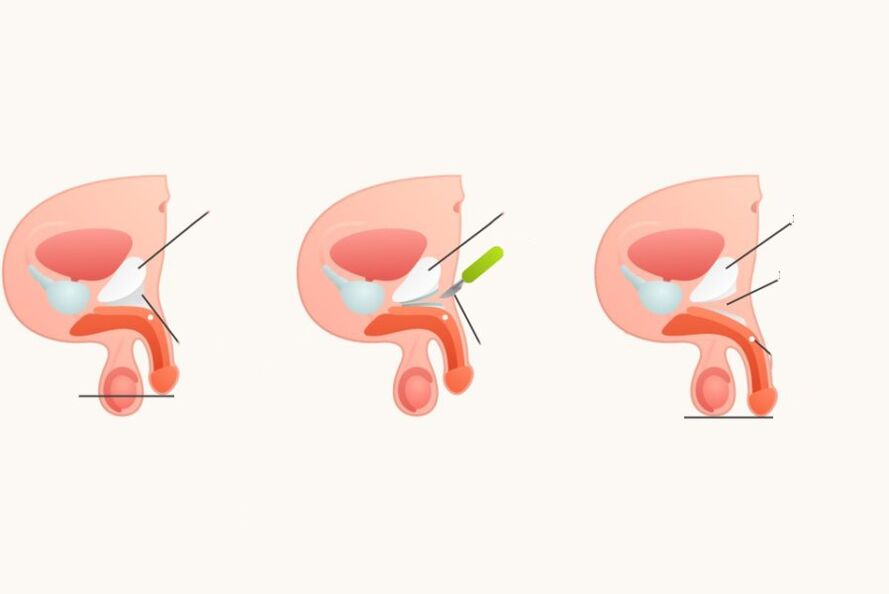 Ligamentomotomie, um den Penis zu erhöhen