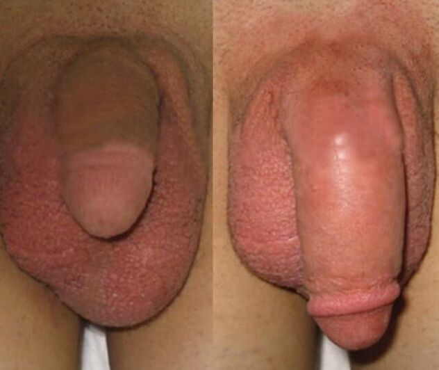 Das Ergebnis der Installation einer Kollagenmatrix im Penis.
