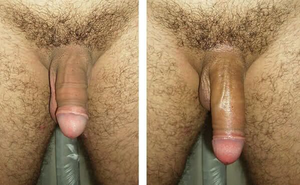 Penis vor und nach Ligamentotomie und Lipofilling