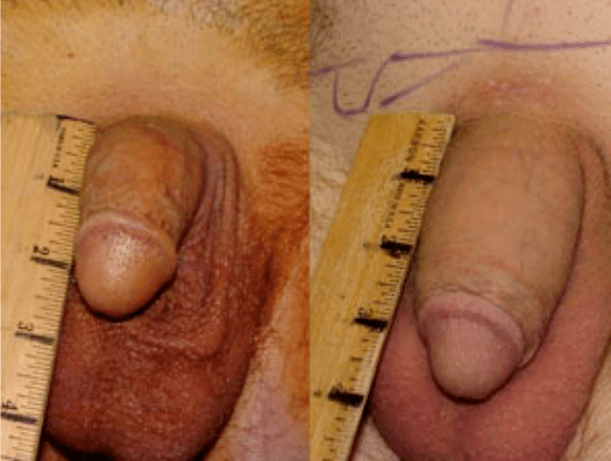 Vor und nach Lipofilling und Gelimplantation.