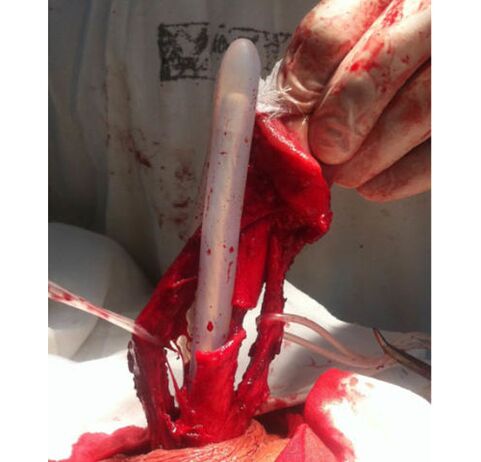 Muskelgewebetransplantation zur Vergrößerung des Penis.